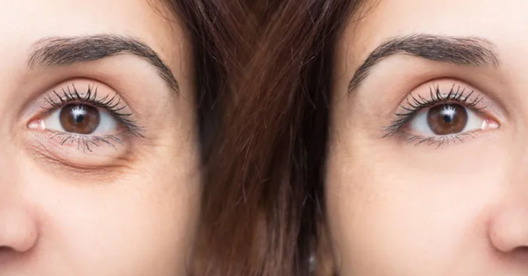 PRP Treatment for Under Eyes