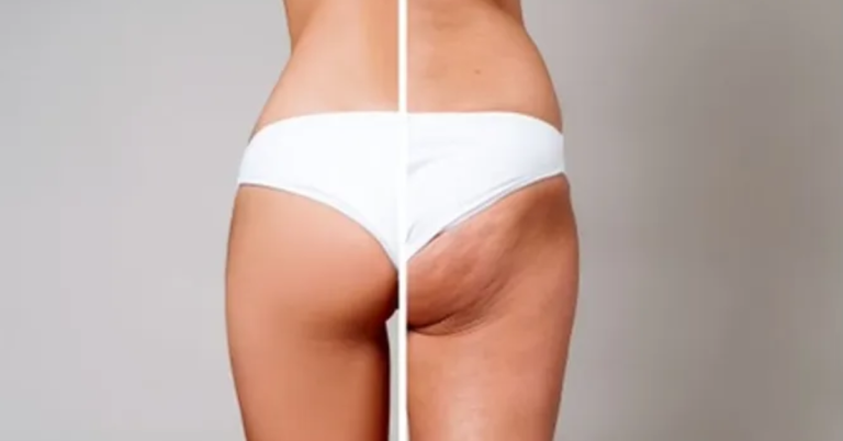 Treatment of Cellulite with PRP (Platelet Rich Plasma)