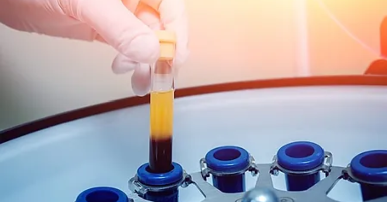 6 Tips to Improve Your PRP Treatment Results